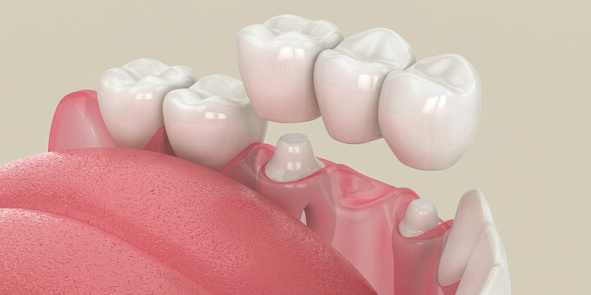 1200x600 dental crowns and bridges 2