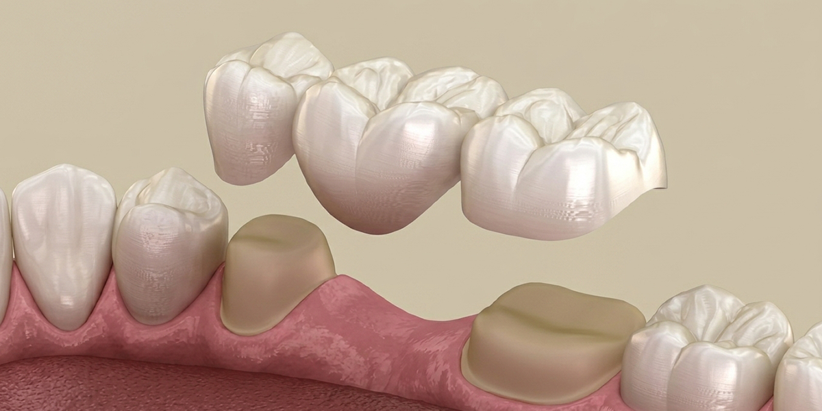 1200x600 dental crowns and bridges