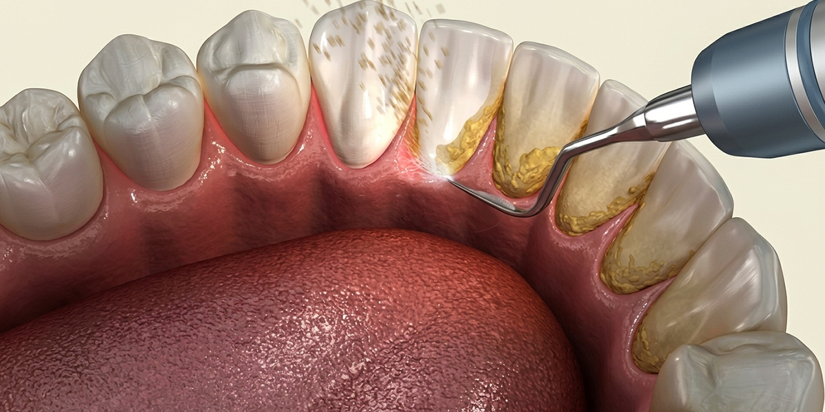 1200x600 professional teeth cleanings 1