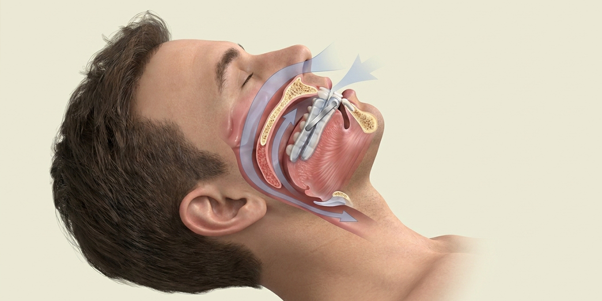 1200x600 sleep apnea treatment
