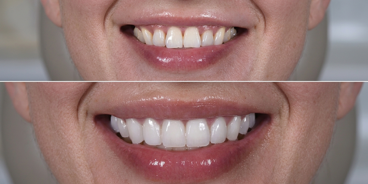 1200x600 veneers 1